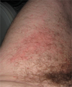 left leg rash 2